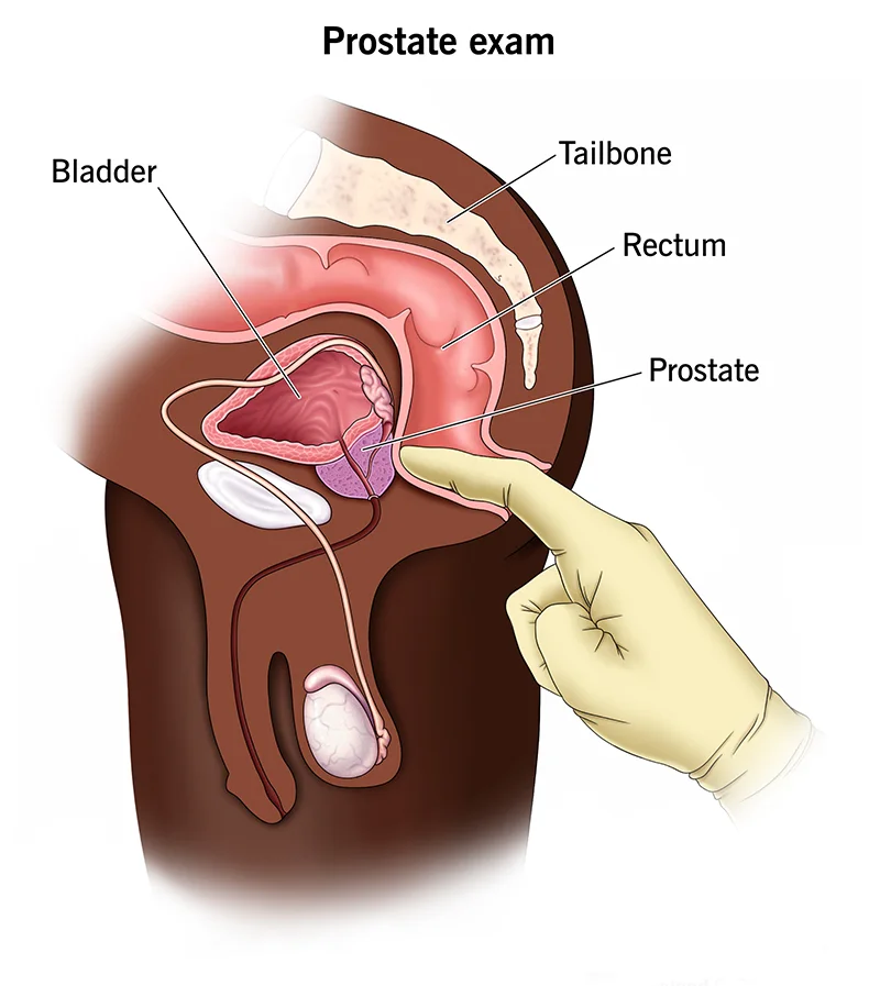 prostate exam 结果